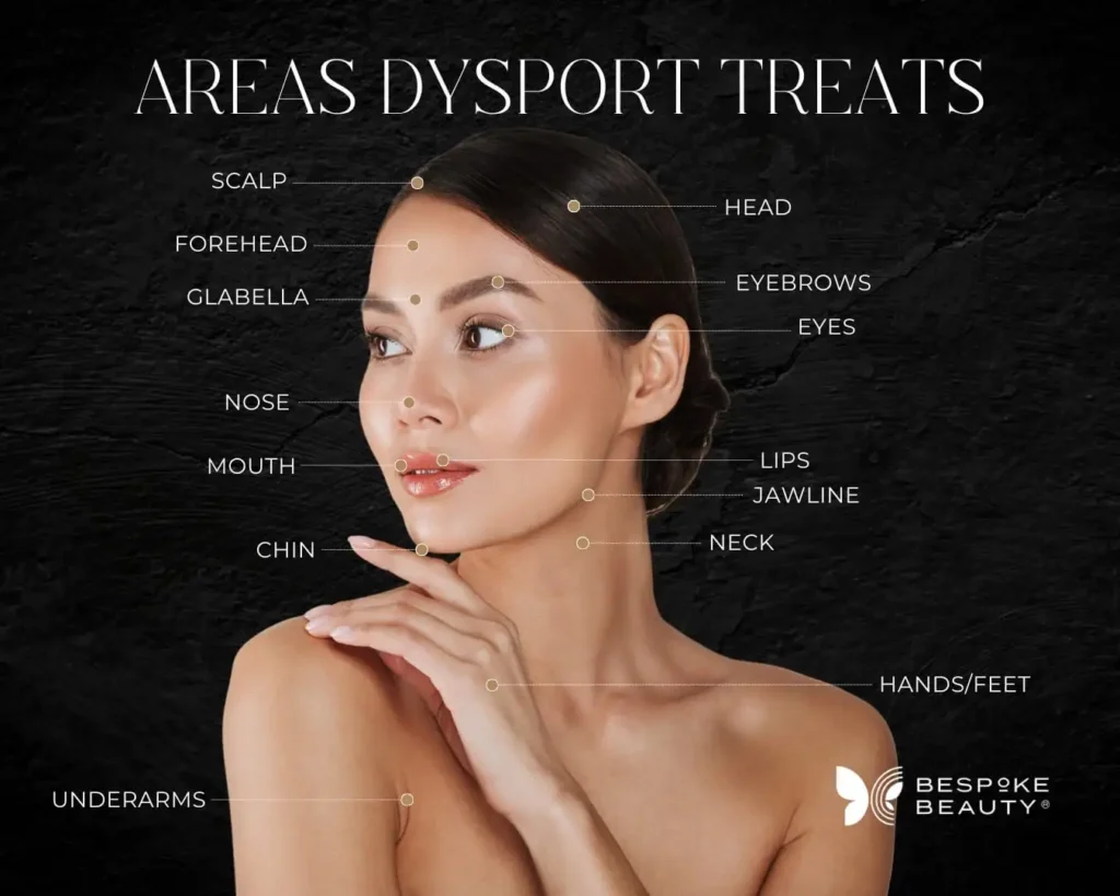Facial areas commonly treated with Dysport