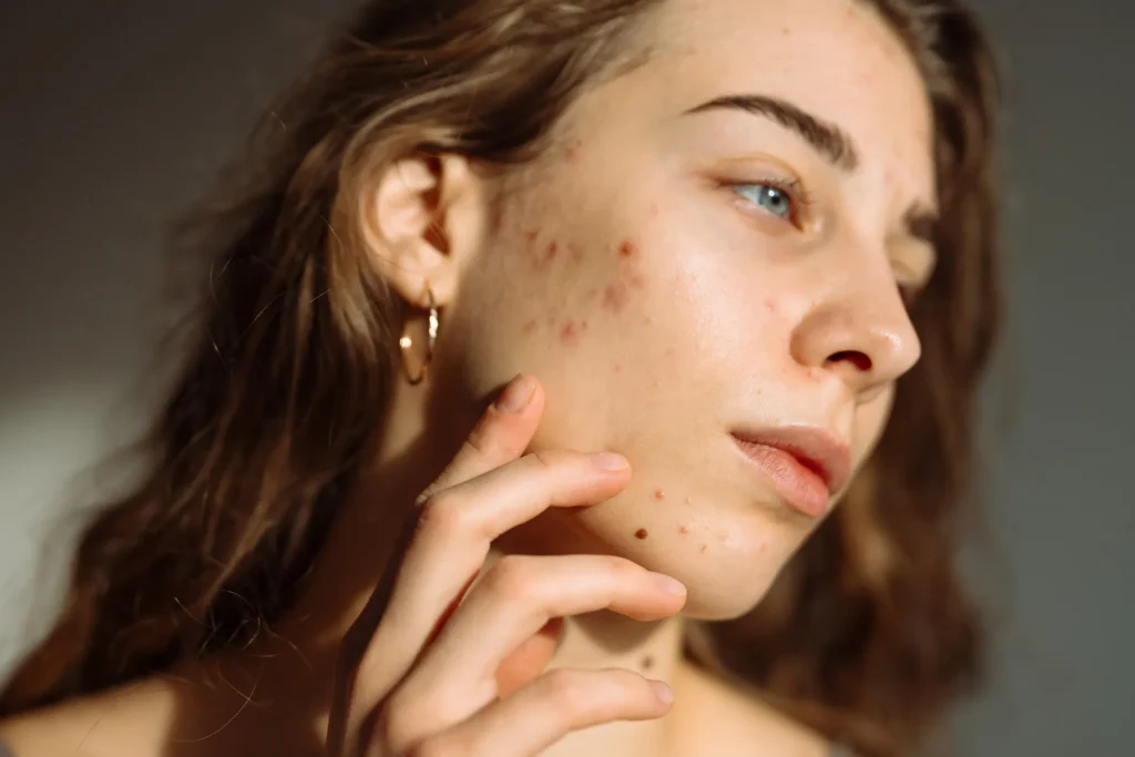 Woman with acne-prone skin for microneedling acne scar treatment