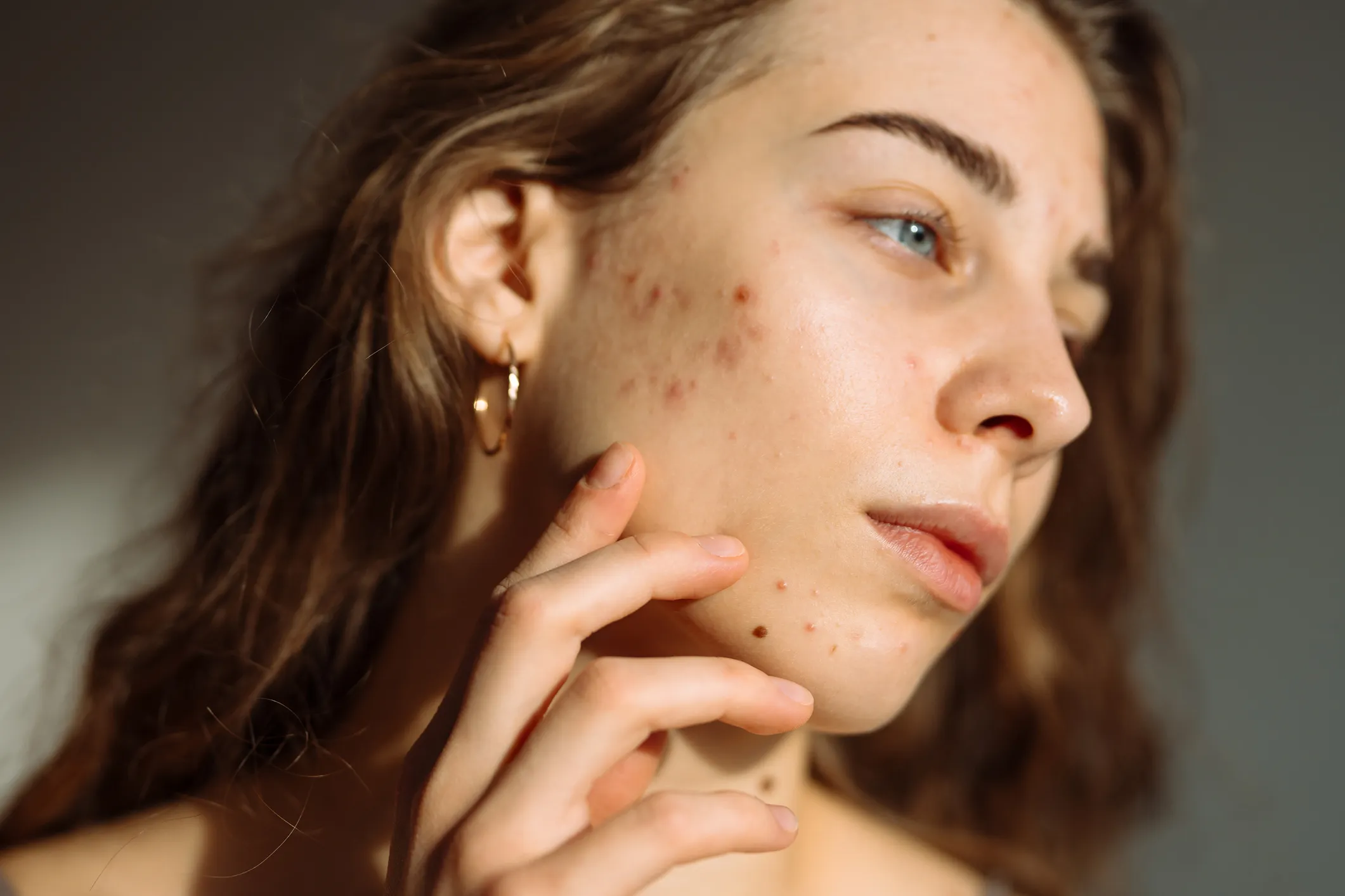 Woman with acne-prone skin for microneedling acne scar treatment